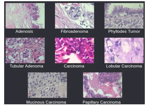 CNN for cancer detection